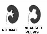 hydronephrosis