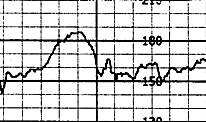 Fetal heart rate acceleration