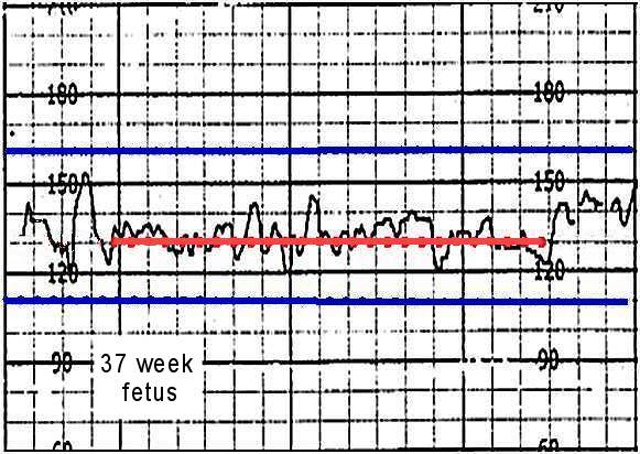 Fetal heart rate