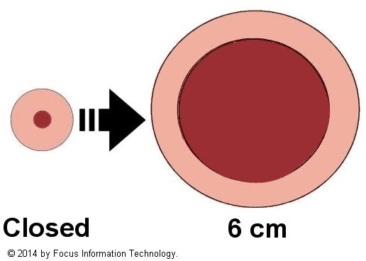 Cervical dilation to 6 centimeters