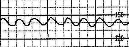 Sinusoidal FHR