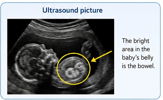 Example ultrasound image with the bright bowel area marked in the baby's abdomen.