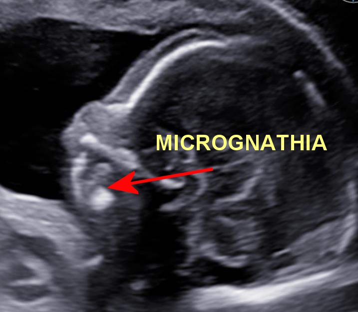Ultrasound showing a fetal side profile with micrognathia