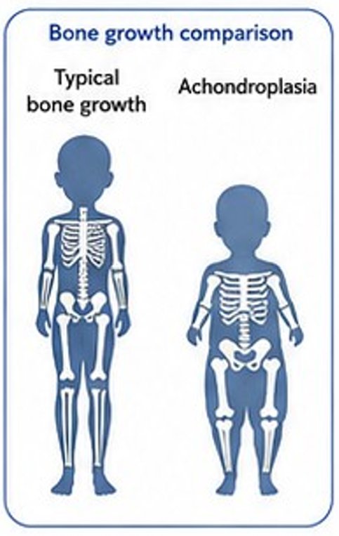 Educational diagram comparing usual bone growth with achondroplasia, showing shorter arm and leg bones with a trunk closer to usual size.
