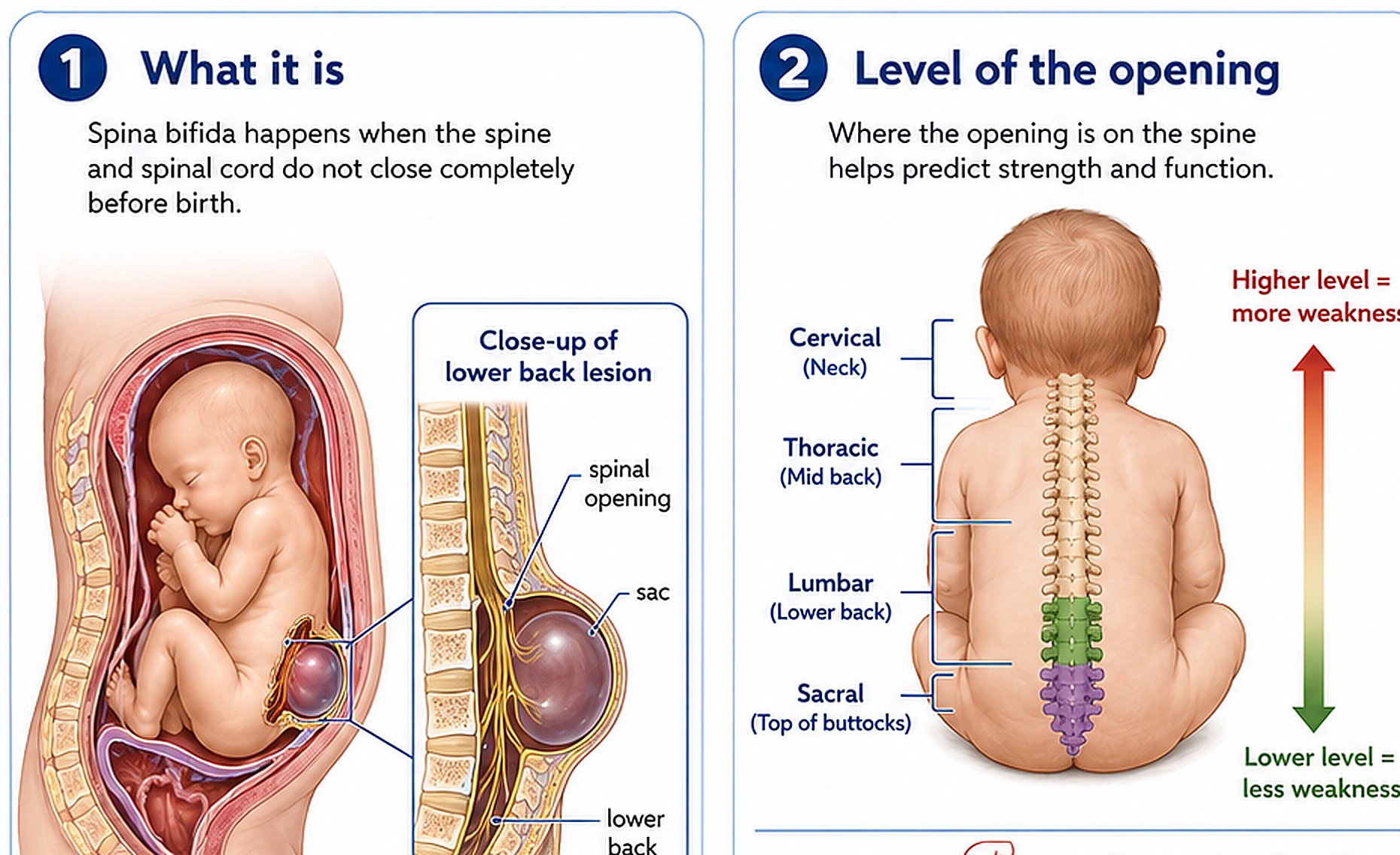 Large patient-friendly illustration showing open spina bifida and the cervical, thoracic, lumbar, and sacral levels of the spine.